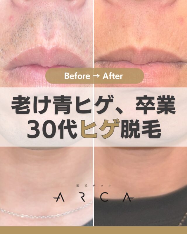 入れ墨やタトゥーがあっても脱毛できる脱毛方法を解説 - 小山市で